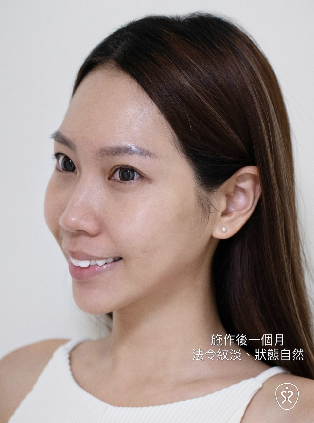 台中星和診所-薇貝拉魔法針滿意成果分享